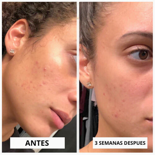 ALTA FRECUENCIA PORTATIL FACIAL Y CORPORAL✅