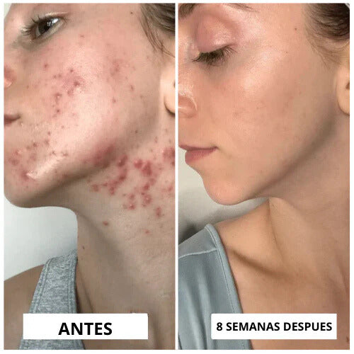 ALTA FRECUENCIA PORTATIL FACIAL Y CORPORAL✅